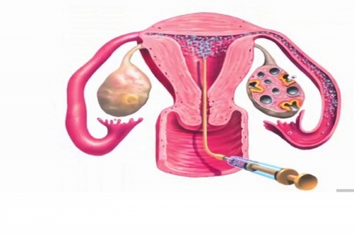 8 Địa chỉ thụ tinh nhân tạo (IUI) uy tín nhất Hà Nội