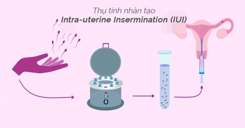 8 địa chỉ thụ tinh nhân tạo (iui) uy tín nhất hà nội