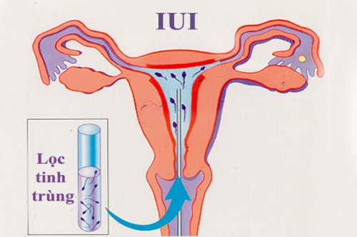 8 địa chỉ thụ tinh nhân tạo (iui) uy tín nhất hà nội