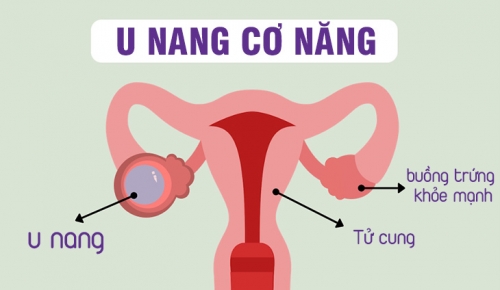 5 nguyên nhân và cách chữa trị u nang buồng trứng