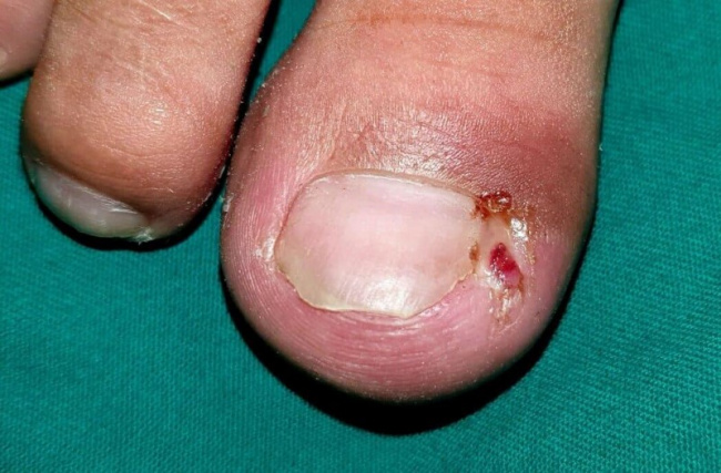 nail đẹp, lấy khóe móng chân bị sưng mủ do đâu và làm sao?