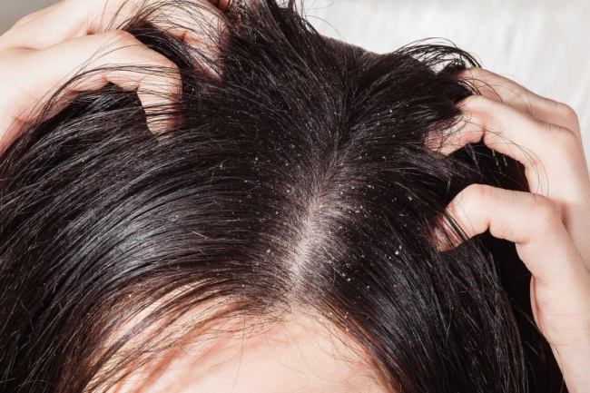 kiểu tóc, tẩy tế bào chết cho da đầu là gì? 5 công thức hiệu quả nhất #1