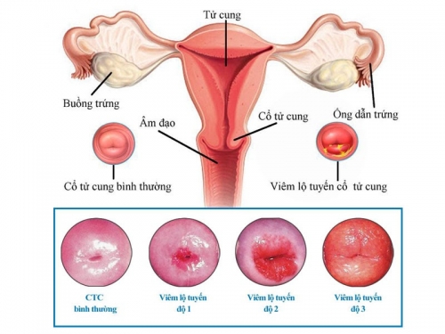 9 nguyên nhân, triệu chứng và cách điều trị viêm lộ tuyến cổ tử cung