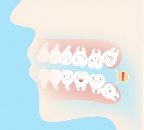 11 điều cần biết trước khi niềng răng