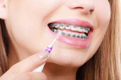 11 điều cần biết trước khi niềng răng