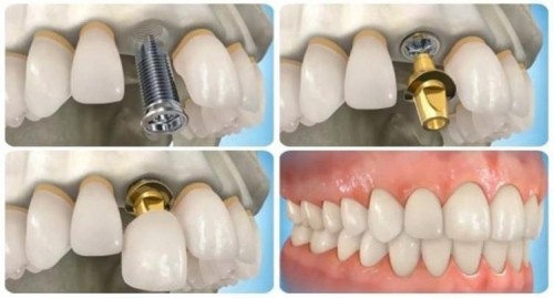 10 quy trình trồng răng implant chuẩn quốc tế