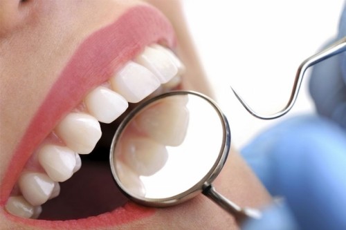 7 điều cần biết khi tẩy trắng răng