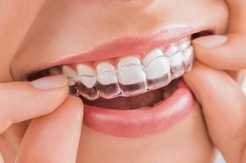 8 Điều cần biết khi niềng răng trong suốt invisalign