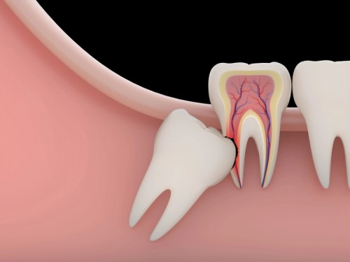 8 Lưu ý quan trọng nhất khi nhổ răng