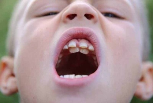8 lưu ý quan trọng nhất khi nhổ răng