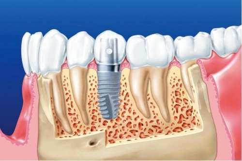 8 Lưu ý quan trọng nhất khi trồng răng implant
