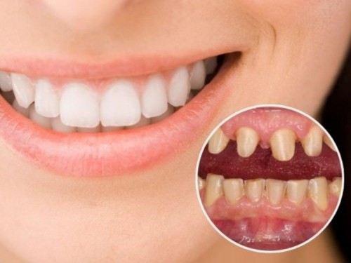 7 Lưu ý quan trọng nhất khi bọc răng sứ