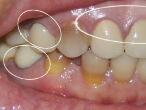 7 lưu ý quan trọng nhất khi bọc răng sứ