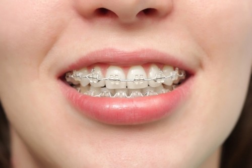 7 lưu ý quan trọng nhất khi bọc răng sứ