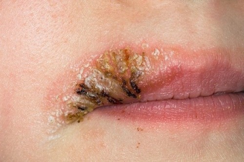 6 hậu quả để lại khi xăm, phun môi