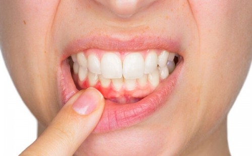 8 lưu ý quan trọng nhất về sưng nướu chân răng