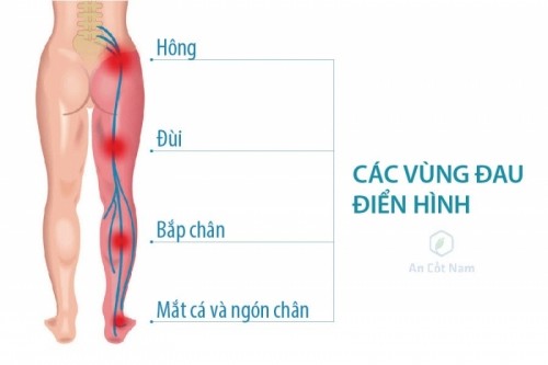 8 lưu ý quan trọng nhất về đau thần kinh tọa