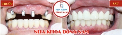 3 giới thiệu về dịch vụ trồng răng Implant của Nha Khoa Đông Nam