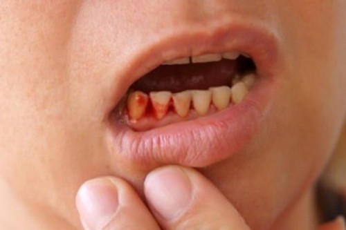 7 nguyên nhân khiến răng lung lay, rụng sớm và cách phòng ngừa