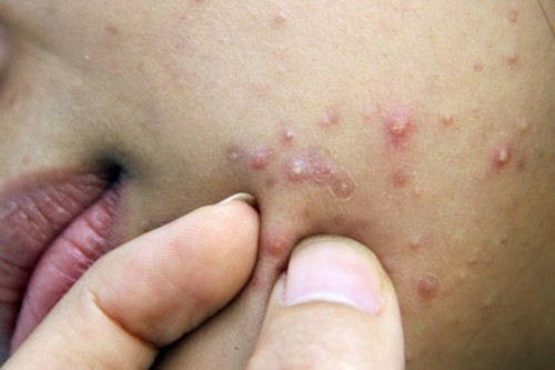 7 bệnh ngoài da thường gặp vào mùa hè và cách phòng tránh