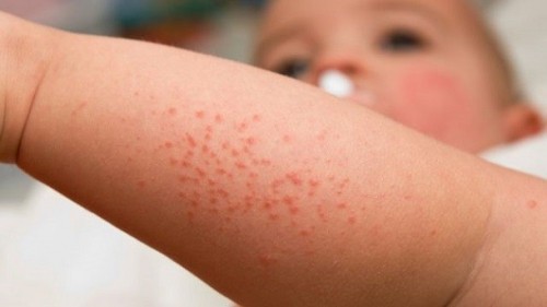 7 bệnh ngoài da thường gặp vào mùa hè và cách phòng tránh