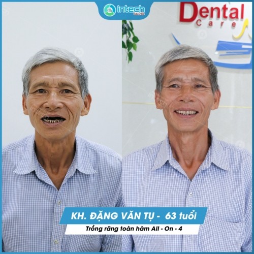 10 địa chỉ trồng răng Implant tốt nhất tại Hà Nội