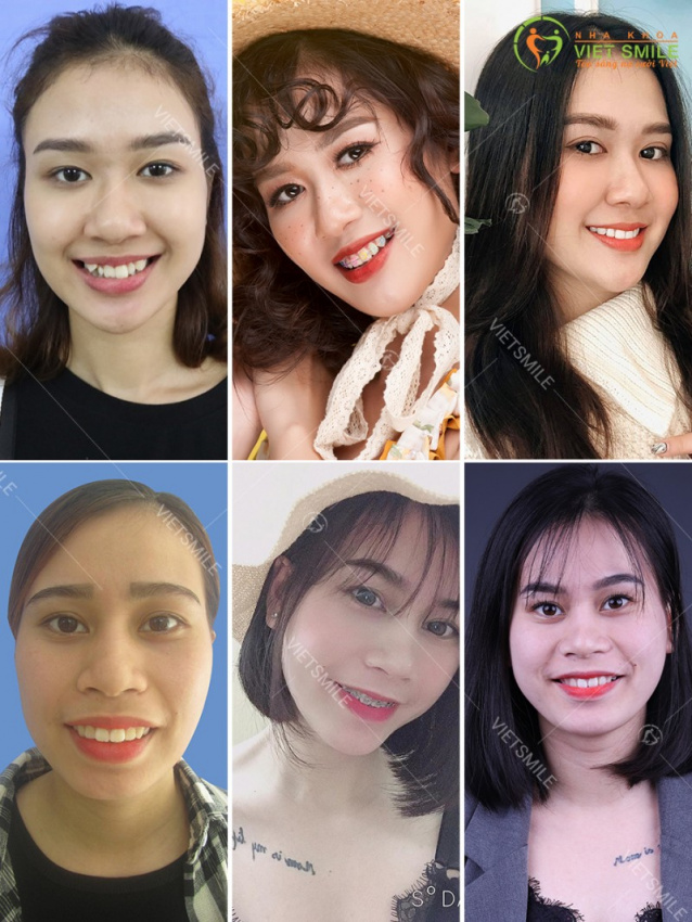 7 Địa chỉ bọc răng sứ thẩm mỹ tốt nhất tại quận Thanh Xuân, Hà Nội