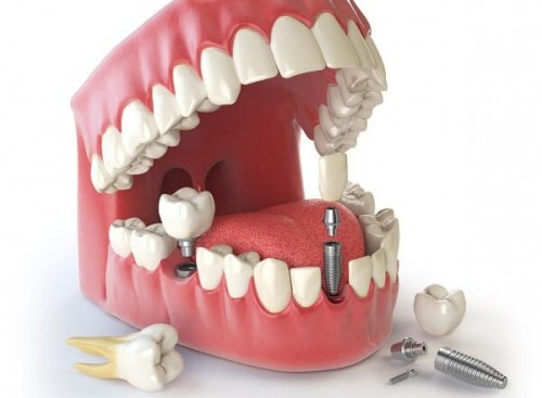 3 Phương pháp trồng răng an toàn và hiệu quả nhất hiện nay