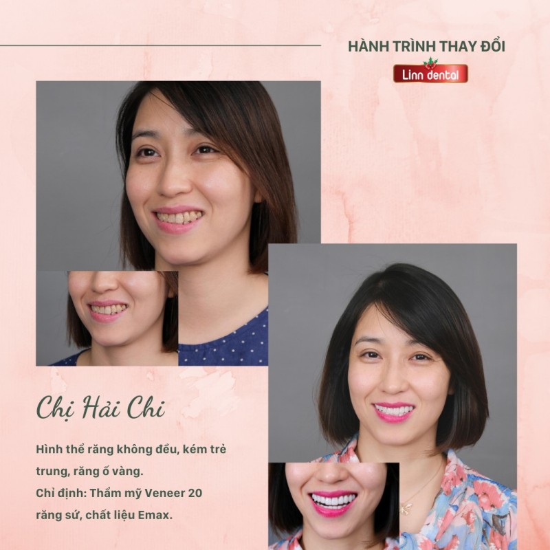 10 Địa chỉ bọc răng sứ thẩm mỹ tốt nhất tại quận Đống Đa, Hà Nội
