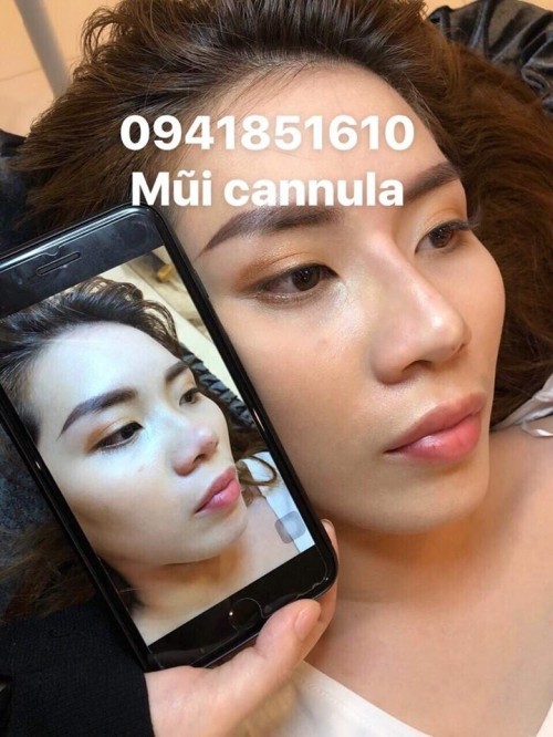 6 địa chỉ tiêm filler - botox uy tín và chất lượng nhất cần thơ