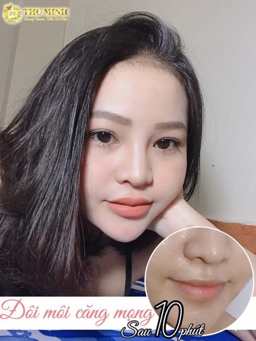 6 địa chỉ tiêm filler - botox uy tín và chất lượng nhất cần thơ