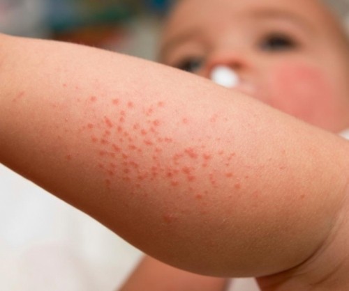 8 bệnh da liễu thường gặp nhất ở trẻ nhỏ