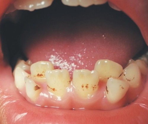 8 nguyên nhân khiến răng bị ố vàng