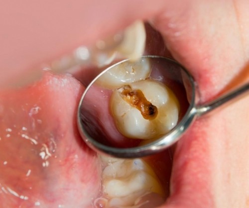 8 nguyên nhân khiến răng bị ố vàng