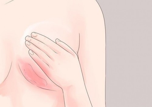 10 dấu hiệu cảnh báo sớm ung thư vú