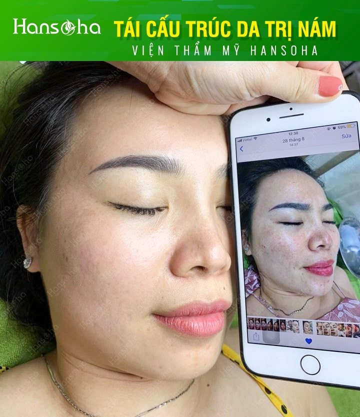 10 spa trị nám tốt nhất tp. việt trì, phú thọ