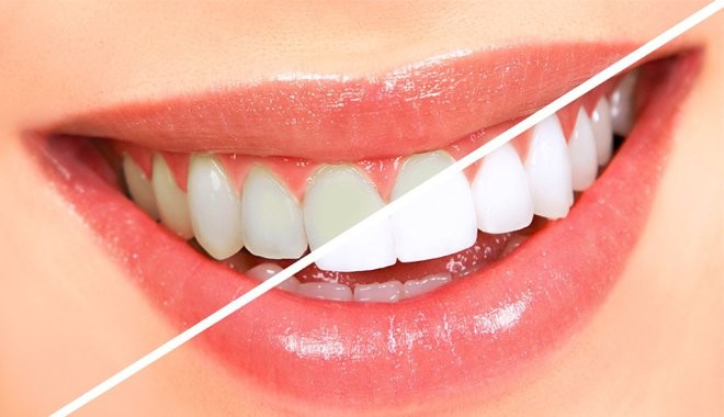 9 địa chỉ tẩy trắng răng hiệu quả, an toàn nhất tại tp hcm
