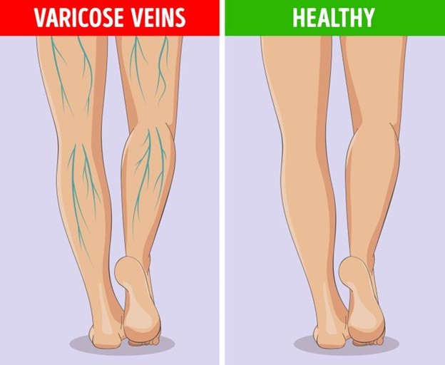 6 Dấu hiệu ở chân có thể cảnh báo về tình hình sức khỏe của bạn