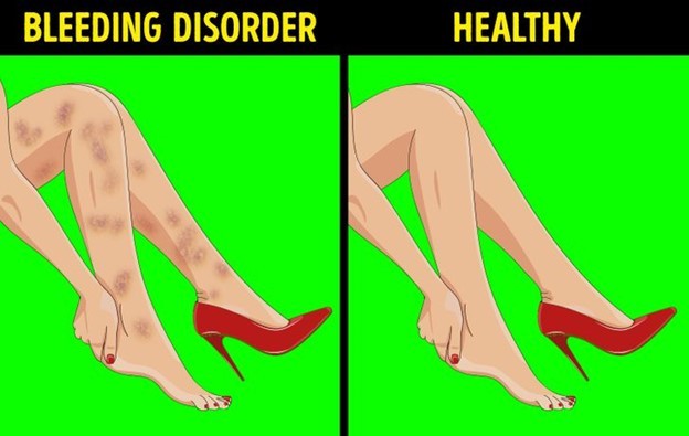6 dấu hiệu ở chân có thể cảnh báo về tình hình sức khỏe của bạn