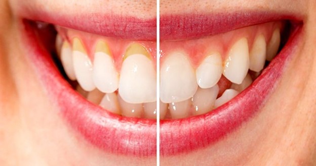 6 cách chăm sóc răng và nướu khỏe mạnh