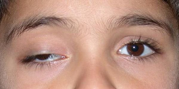 6 nguyên nhân khiến mắt nhức mỏi sau khi ngủ dậy, cần khắc phục