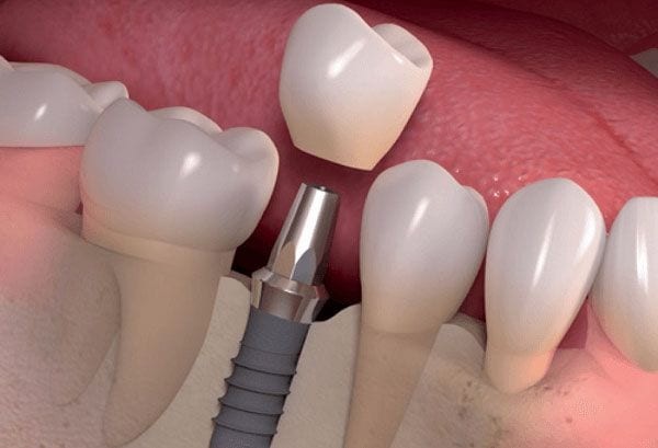 9 địa chỉ trồng răng implant uy tín nhất quận long biên, hà nội