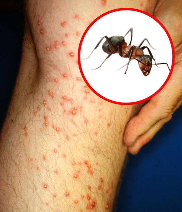 8 Mẹo nhận biết vết côn trùng cắn và cách xử lý hiệu quả nhất