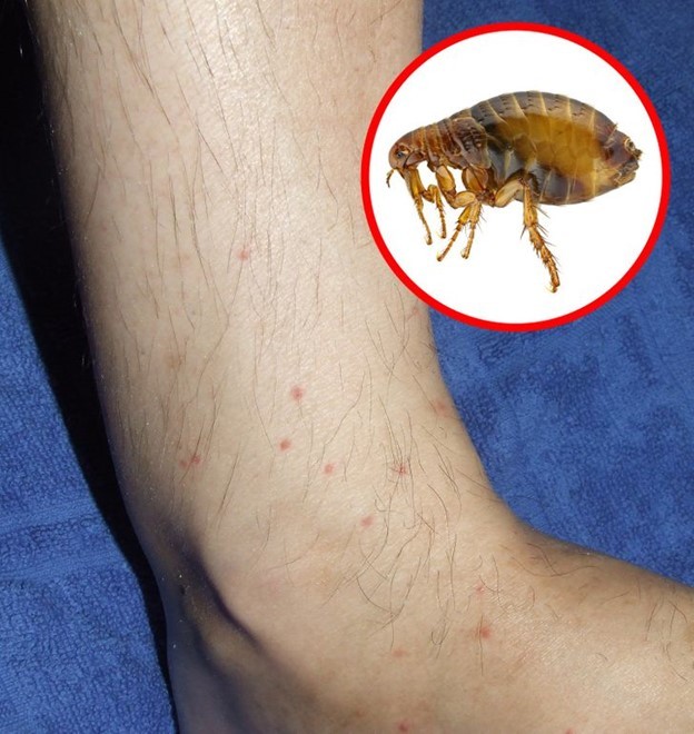 8 mẹo nhận biết vết côn trùng cắn và cách xử lý hiệu quả nhất