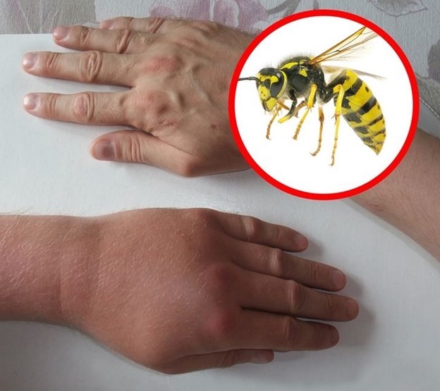 8 mẹo nhận biết vết côn trùng cắn và cách xử lý hiệu quả nhất