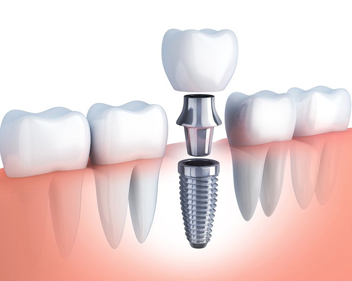 5 Địa chỉ trồng răng implant tốt nhất tỉnh Quảng Ngãi