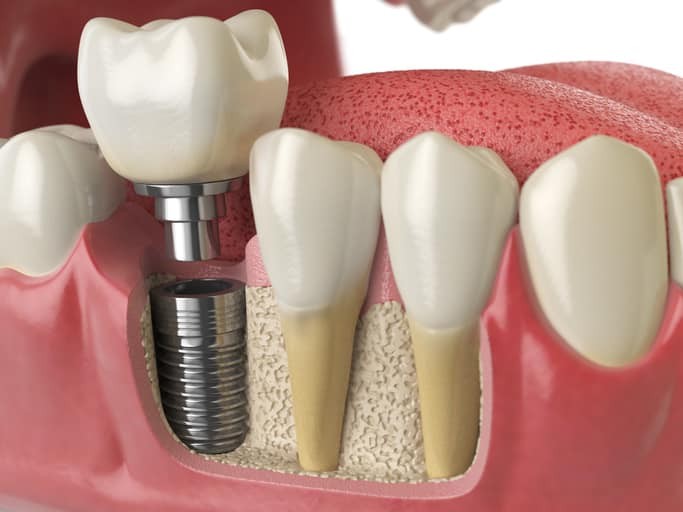 4 địa chỉ trồng răng implant tốt nhất tỉnh bình định