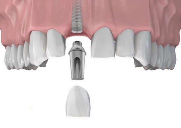 5 Địa chỉ trồng răng implant tốt nhất tỉnh Đắk Nông