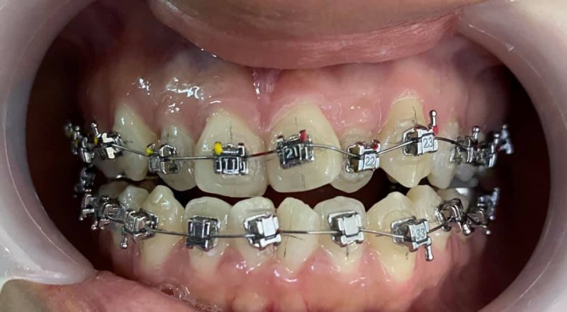 5 địa chỉ trồng răng implant tốt nhất tỉnh đắk nông