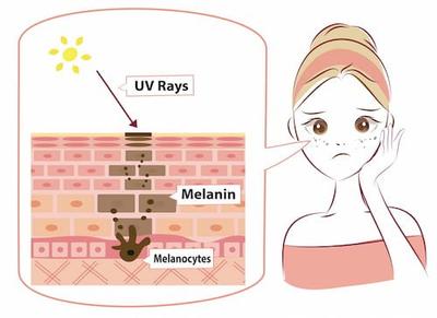 bạn đã biết hắc sắc tố melanin thật sự là gì và cách giúp da mặt không sản xuất melanin chưa?